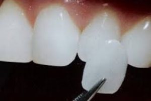 Diş kaplama nedir?