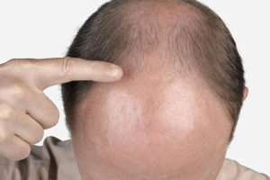 Erkeklerde saç dökülmesine iyi gelen vitaminler