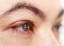 Arpacık nedir, Arpacık neden olur ve nasıl geçer?