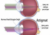 Astigmat Göz Hastalığı nedir? Nasıl tedavi edilir? Astigmat Göz Hastalığı nedir? Nasıl tedavi edilir?