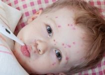 Kızamıkçık (Rubella) Nedir? Belirtileri ve Tedavisi