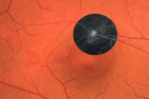 Santral Seröz Retinopati Nedir Belirtileri ve Tedavisi