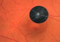 Santral Seröz Retinopati Nedir Belirtileri ve Tedavisi Santral Seröz Retinopati Nedir Belirtileri ve Tedavisi