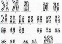 Süper Dişi Sendromu nedir, belirtileri nelerdir tedavisi var mı? Süper Dişi Sendromu nedir, belirtileri nelerdir tedavisi var mı?