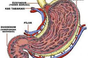 Ülser nedir? Belirtileri ve tedavisi nelerdir?