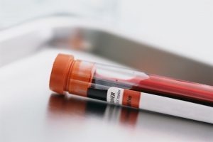 Karaciğer fonksiyon testleri ve anlamları