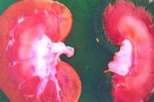 Böbrek küçülmesi nedir, belirtileri ve tedavisi nelerdir?