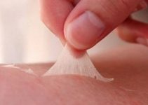 Deri soyulması nedenleri ve tedavisi Deri soyulması nedenleri ve tedavisi