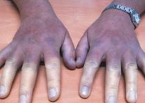 Raynaud (Reyno) hastalığı Belirtileri ve tedavisi