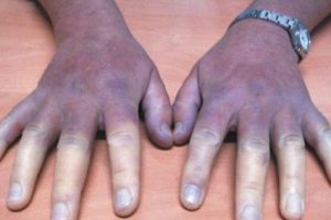 Raynaud (Reyno) hastalığı Belirtileri ve tedavisi