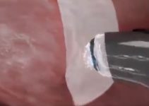 Bademcik ve adenoid ameliyatı nasıl yapılır?