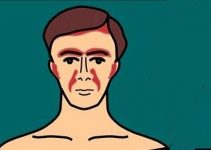 Seboreik dermatit nedir belirtileri ve tedavisi Seboreik dermatit nedir belirtileri ve tedavisi